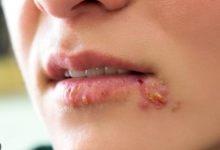 How to Stop Compulsive Skin Picking