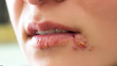 How to Stop Compulsive Skin Picking