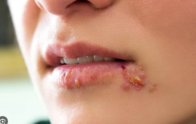 How to Stop Compulsive Skin Picking